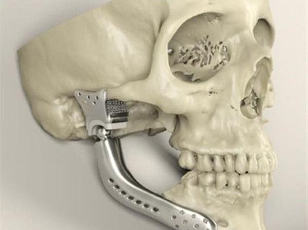 簡述3D打印技術在醫(yī)療行業(yè)應用情況_e鍵3D打印服務