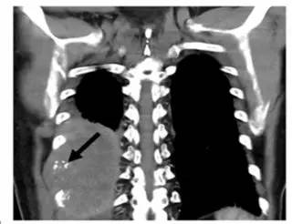 第四軍醫(yī)大學(xué)精彩分享個性化醫(yī)療3D打印的實戰(zhàn)案例與研究成果 第四軍醫(yī)大學(xué)精彩分享個性化醫(yī)療3D打印的實戰(zhàn)案例與研究成果