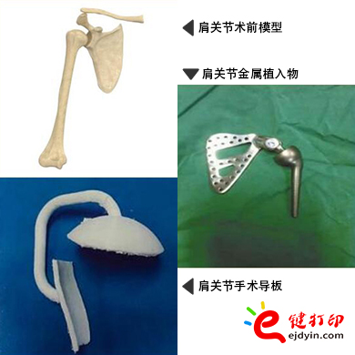 肩關(guān)節(jié)金屬植入物